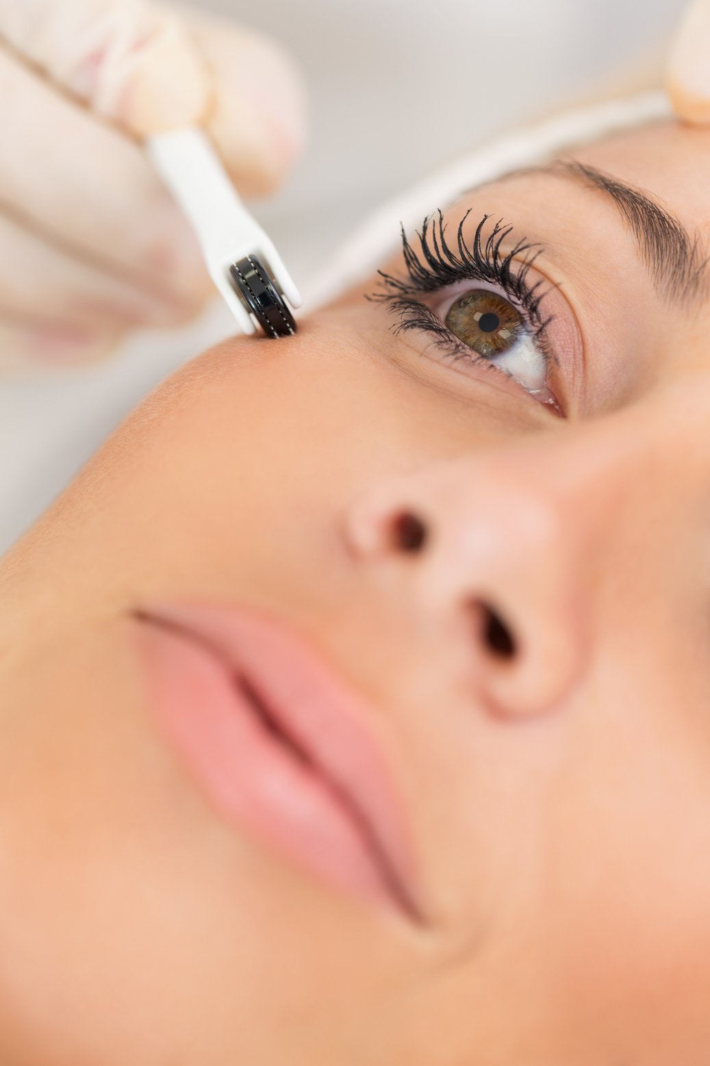 Needle mesotherapy