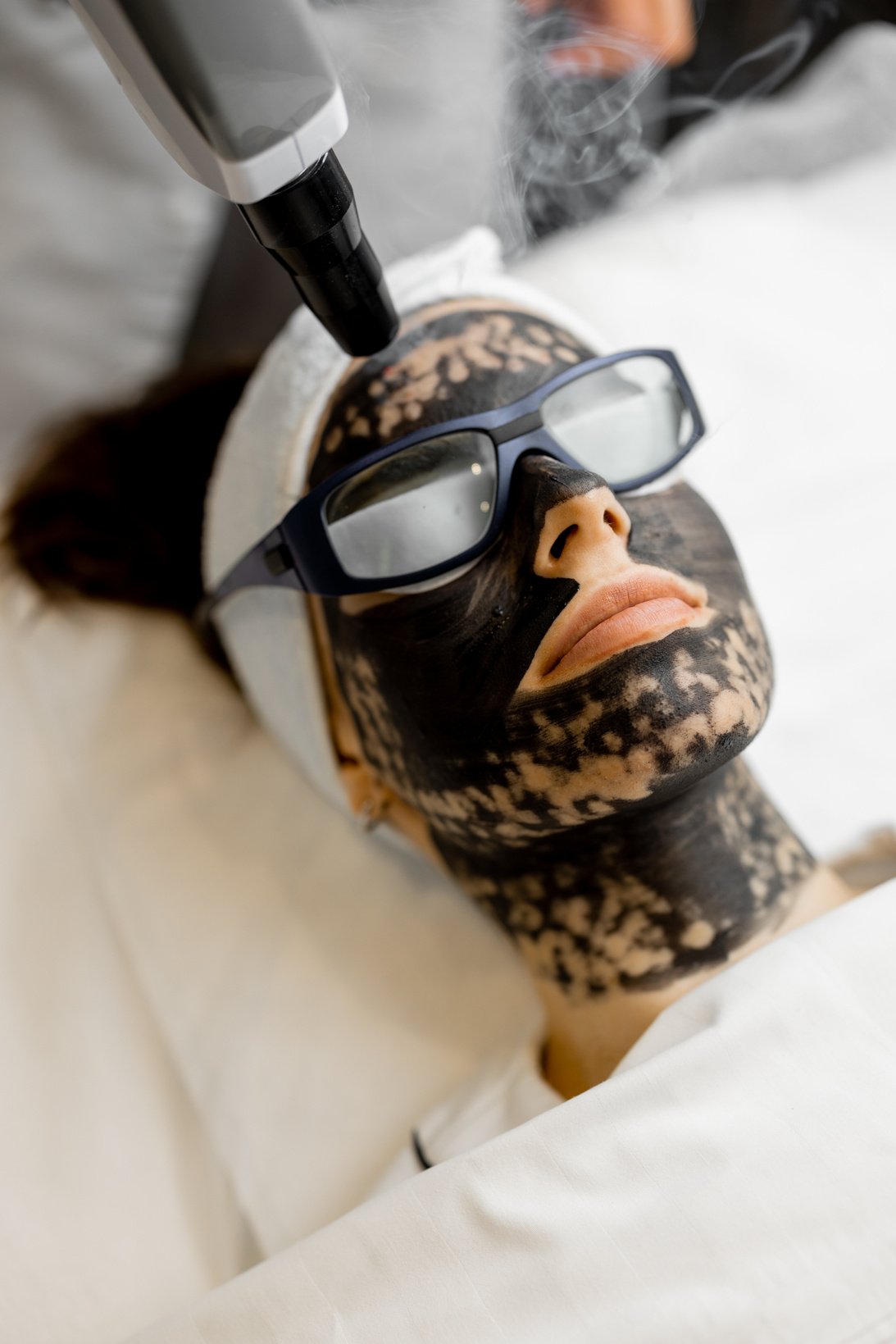 Woman Getting a Laser Carbon Peel Facial