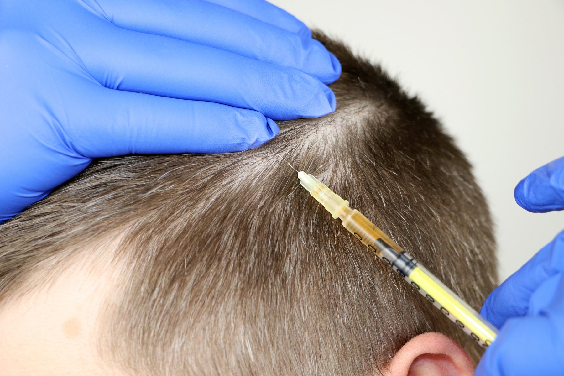 Hair Mesotherapy or Hair Transplant